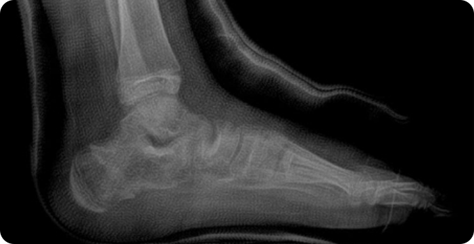 X-ray 사진