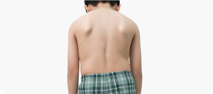 척추측만증 관련 이미지