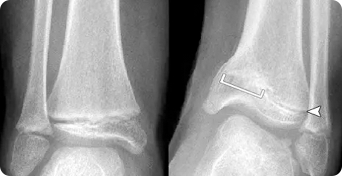 X-ray 사진